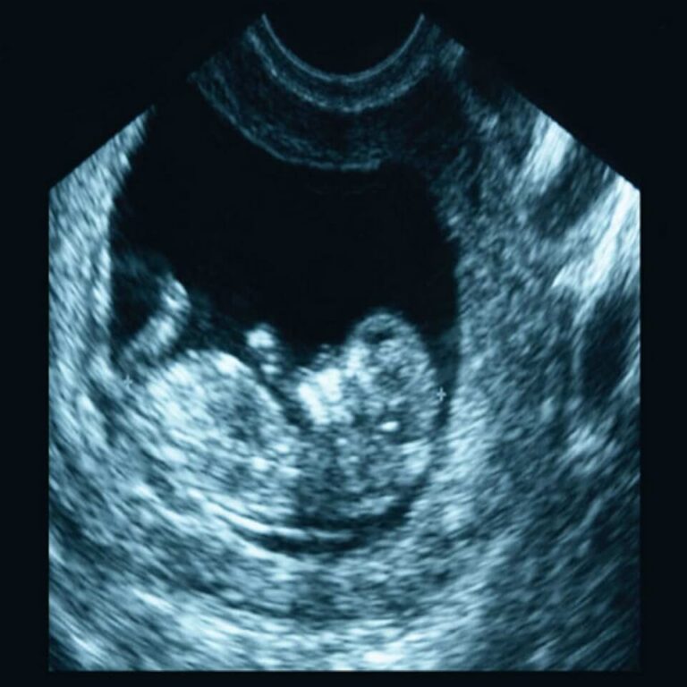ARDMS Ultrasound Flashcards